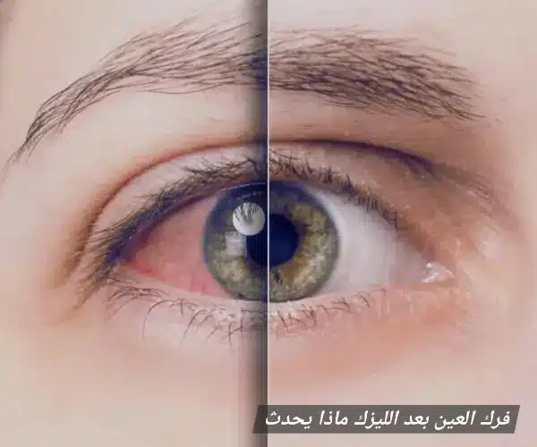 1000429273 فرك العين بعد الليزك ماذا يحدث