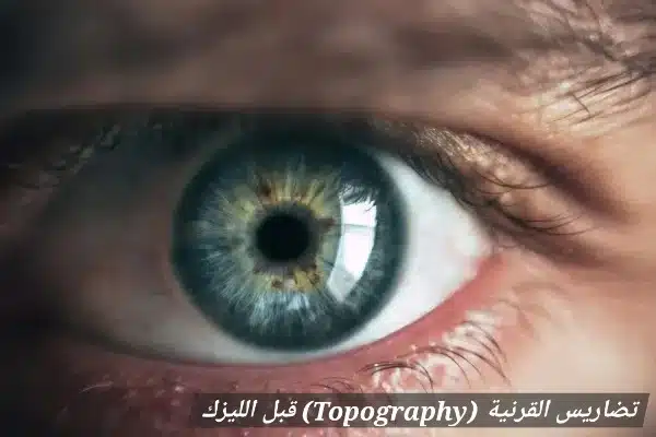 1000439987 تضاريس القرنية (Topography) قبل الليزك