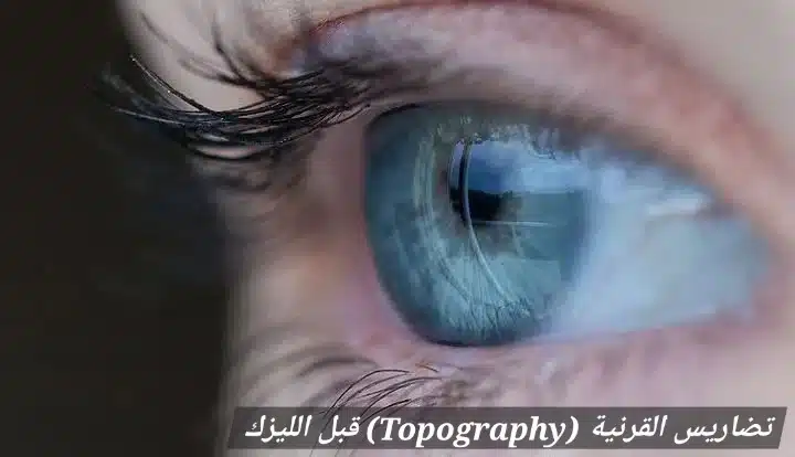 1000439988 تضاريس القرنية (Topography) قبل الليزك