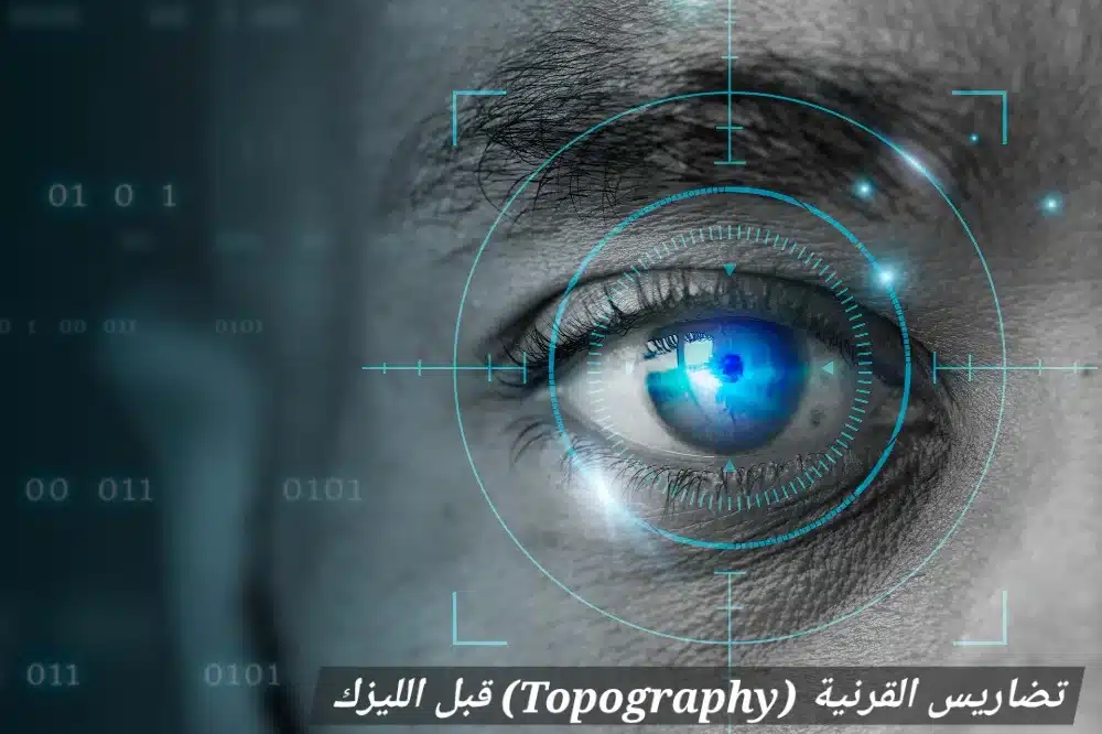تضاريس القرنية (Topography) قبل الليزك

