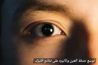 1000441210 توسع حدقة العين وتأثيره على نتائج الليزك
