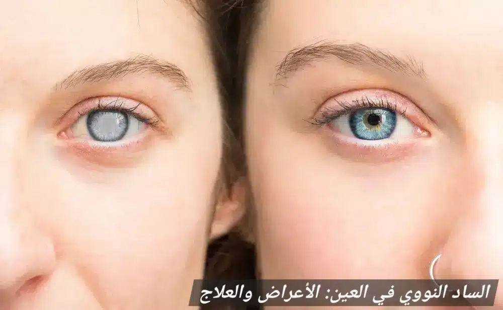 الساد النووي في العين: الأعراض والعلاج
