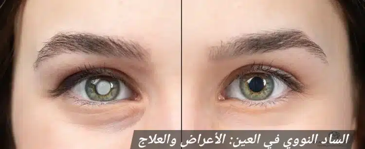 1000443915 الساد النووي في العين: الأعراض والعلاج