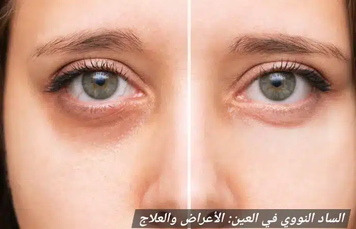 1000443916 الساد النووي في العين: الأعراض والعلاج