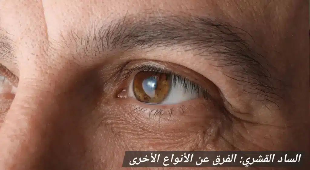 1000446142 الساد القشري: الفرق عن الأنواع الأخرى