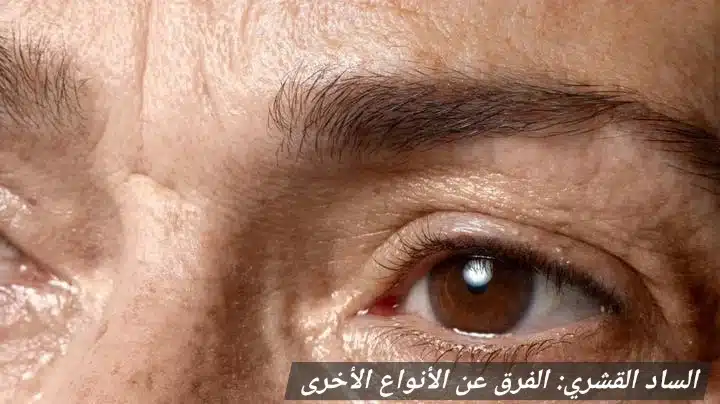 1000446144 الساد القشري: الفرق عن الأنواع الأخرى