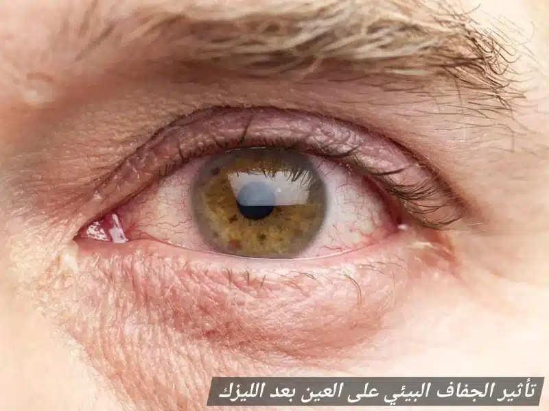 1000447506 تأثير الجفاف البيئي على العين بعد الليزك