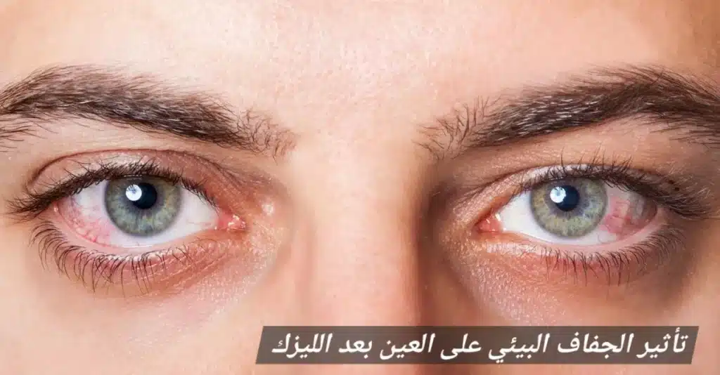 1000447507 تأثير الجفاف البيئي على العين بعد الليزك