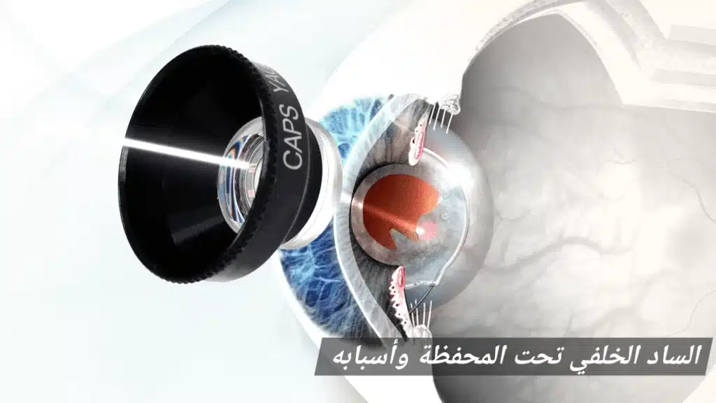 1000450080 الساد الخلفي تحت المحفظة وأسبابه