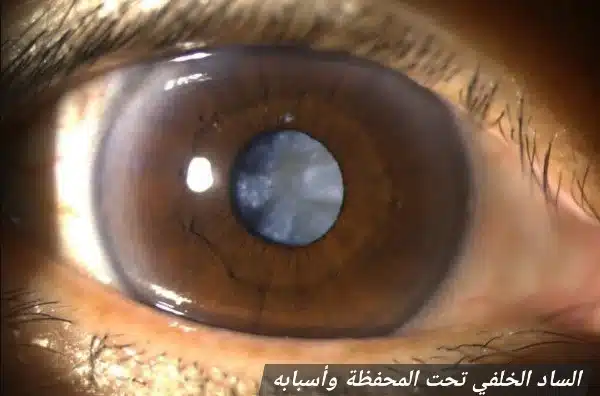 1000450081 الساد الخلفي تحت المحفظة وأسبابه