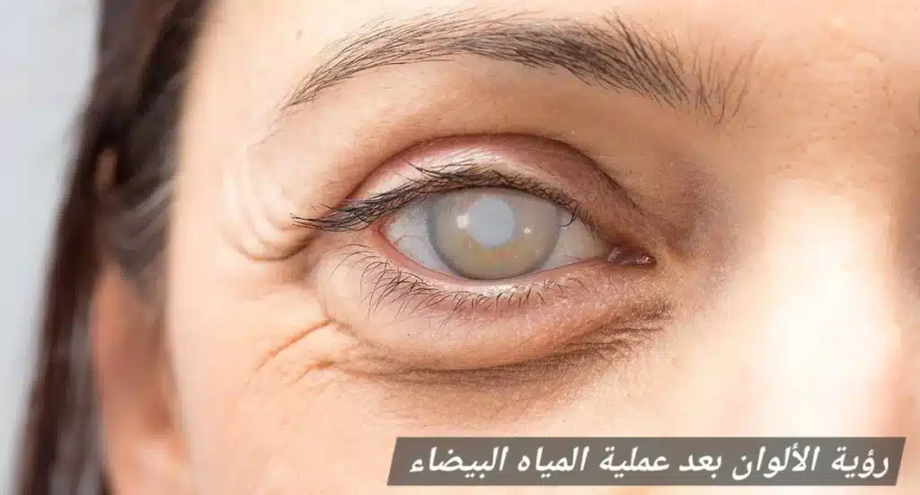 رؤية الألوان بعد عملية المياه البيضاء 1 1000451259 رؤية الألوان بعد عملية المياه البيضاء