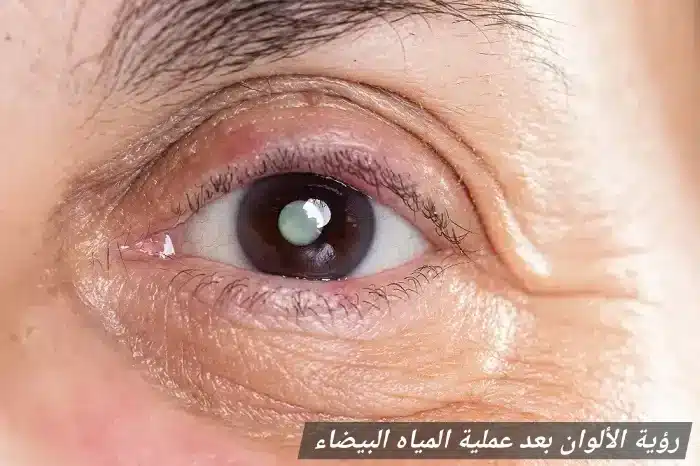 رؤية الألوان بعد عملية المياه البيضاء 2 1000451260 رؤية الألوان بعد عملية المياه البيضاء