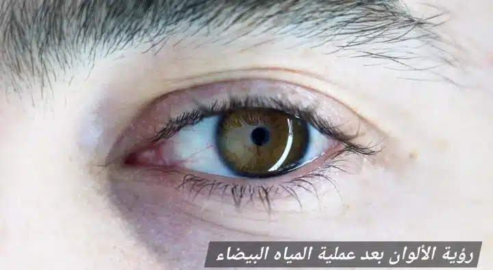 رؤية الألوان بعد عملية المياه البيضاء 3 رؤية الألوان بعد عملية المياه البيضاء