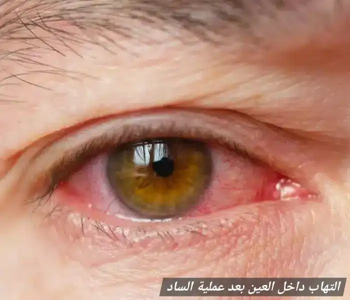 التهاب داخل العين بعد عملية الساد 1 التهاب داخل العين بعد عملية الساد