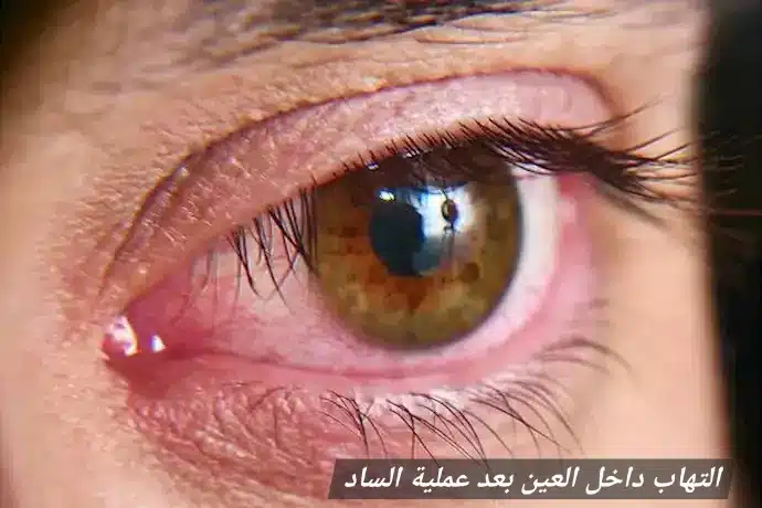 التهاب داخل العين بعد عملية الساد 3 1000452061 التهاب داخل العين بعد عملية الساد