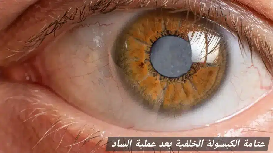 1000452708 عتامة الكبسولة الخلفية بعد عملية الساد