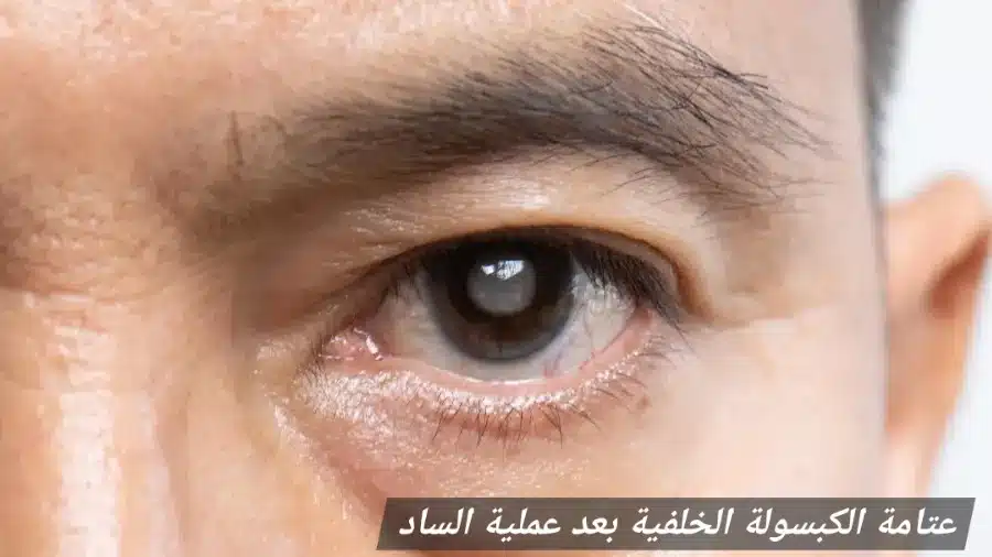1000452709 عتامة الكبسولة الخلفية بعد عملية الساد