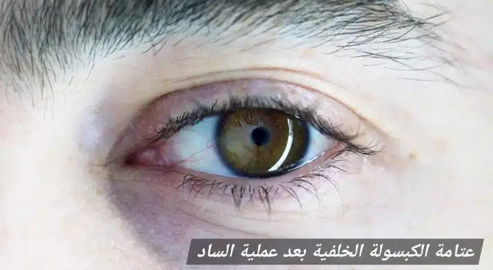 عتامة الكبسولة الخلفية بعد عملية الساد
