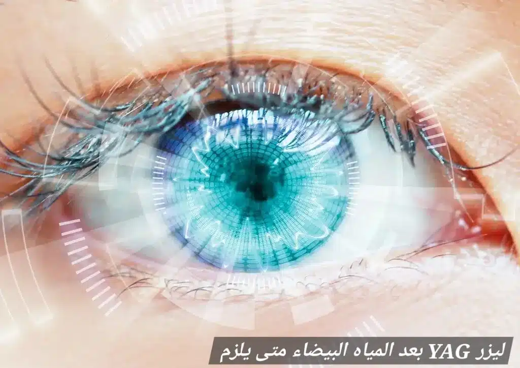 ليزر YAG بعد المياه البيضاء متى يلزم 3 1000452899 ليزر YAG بعد المياه البيضاء متى يلزم