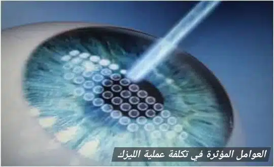 1000460950 العوامل المؤثرة في تكلفة عملية الليزك