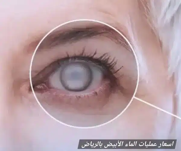 اسعار عمليات الماء الأبيض بالرياض

