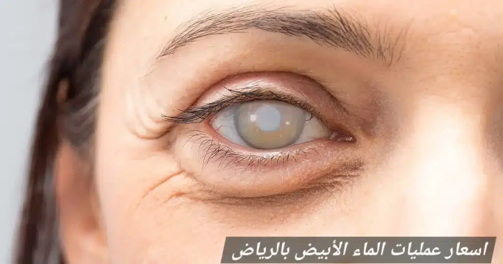 1000463243 اسعار عمليات الماء الأبيض بالرياض