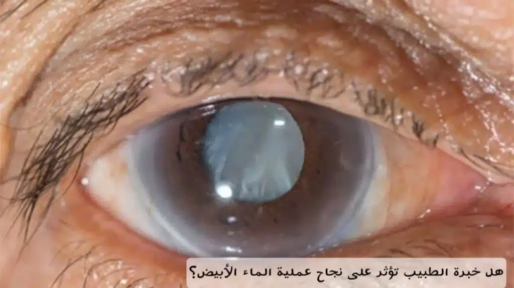 هل خبرة الطبيب تؤثر على نجاح عملية الماء الأبيض؟
