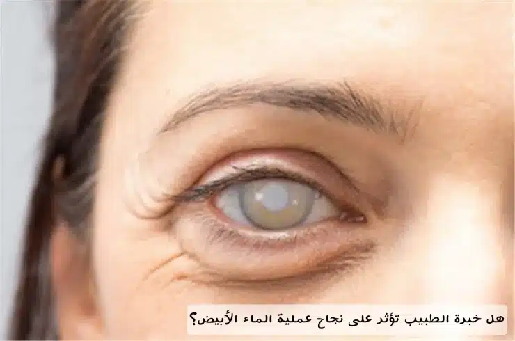 1000478115 هل خبرة الطبيب تؤثر على نجاح عملية الماء الأبيض؟