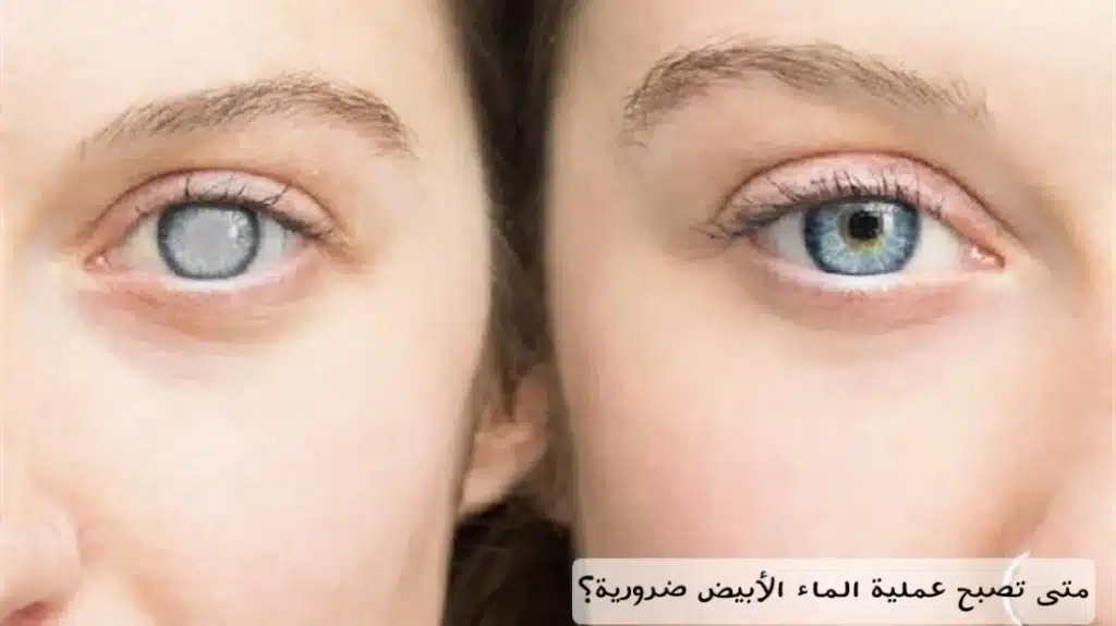 1000479244 1 متى تصبح عملية الماء الأبيض ضرورية؟