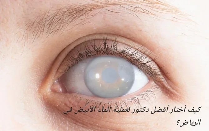 image 21 كيف أختار أفضل دكتور لعملية الماء الأبيض في الرياض؟