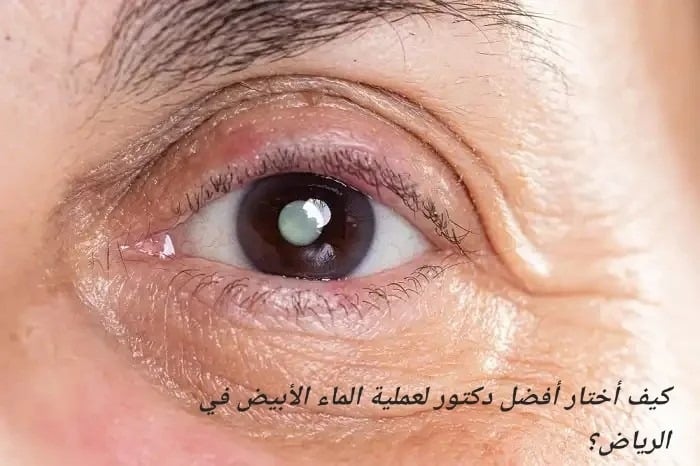 كيف أختار أفضل دكتور لعملية الماء الأبيض في الرياض؟
