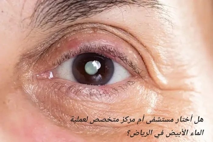 image 23 هل أختار مستشفى أم مركز متخصص لعملية الماء الأبيض في الرياض؟