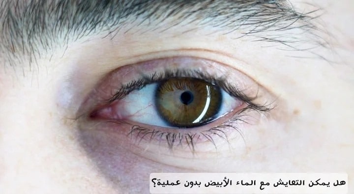 هل يمكن التعايش مع الماء الأبيض بدون عملية؟ 3 image 25 هل يمكن التعايش مع الماء الأبيض بدون عملية؟