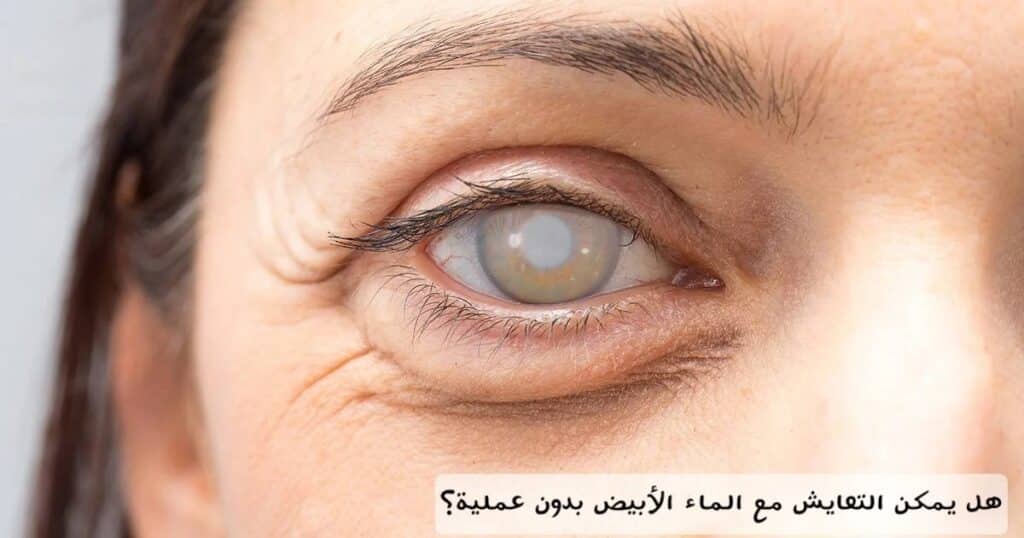 هل يمكن التعايش مع الماء الأبيض بدون عملية؟ 1 هل يمكن التعايش مع الماء الأبيض بدون عملية؟