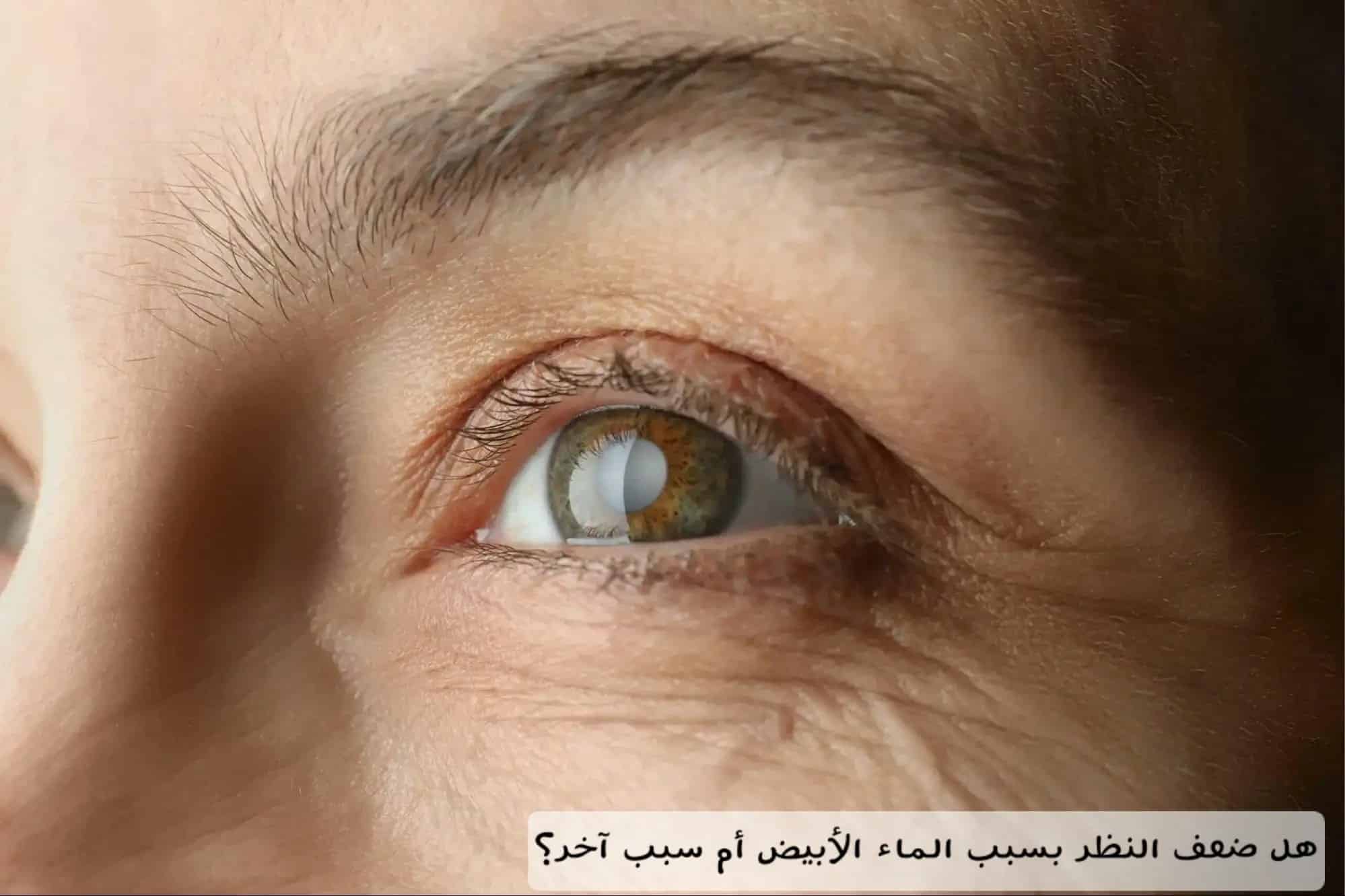 هل ضعف النظر بسبب الماء الأبيض أم سبب آخر؟ 2 image 28 هل ضعف النظر بسبب الماء الأبيض أم سبب آخر؟
