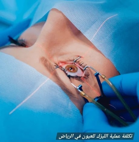 تكلفة عملية الليزك للعيون في الرياض
