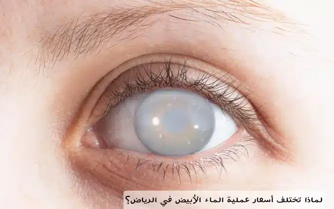 1000485842 لماذا تختلف أسعار عملية الماء الأبيض في الرياض؟