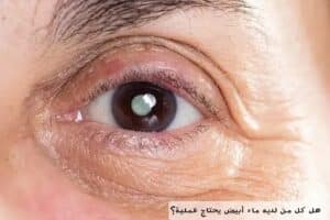 هل كل من لديه ماء أبيض يحتاج عملية؟