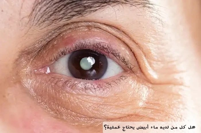 هل كل من لديه ماء أبيض يحتاج عملية؟
