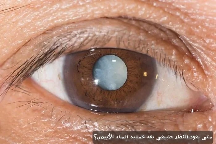 متى يعود النظر طبيعي بعد عملية الماء الأبيض؟
