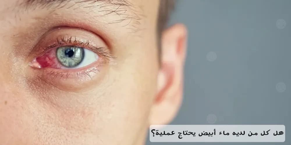 image هل كل من لديه ماء أبيض يحتاج عملية؟