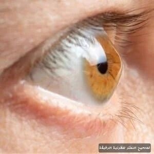 تصحيح النظر للقرنية الرقيقة 3 image 10 تصحيح النظر للقرنية الرقيقة