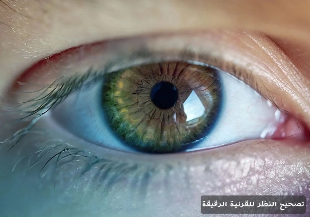 تصحيح النظر للقرنية الرقيقة 1 تصحيح النظر للقرنية الرقيقة