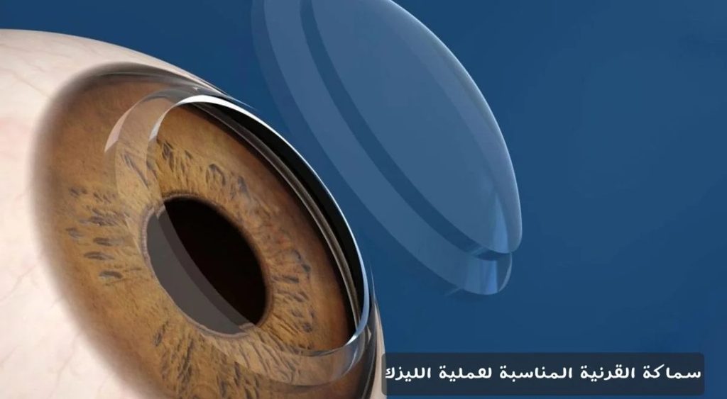 سماكة القرنية المناسبة لعملية الليزك 1 سماكة القرنية المناسبة لعملية الليزك