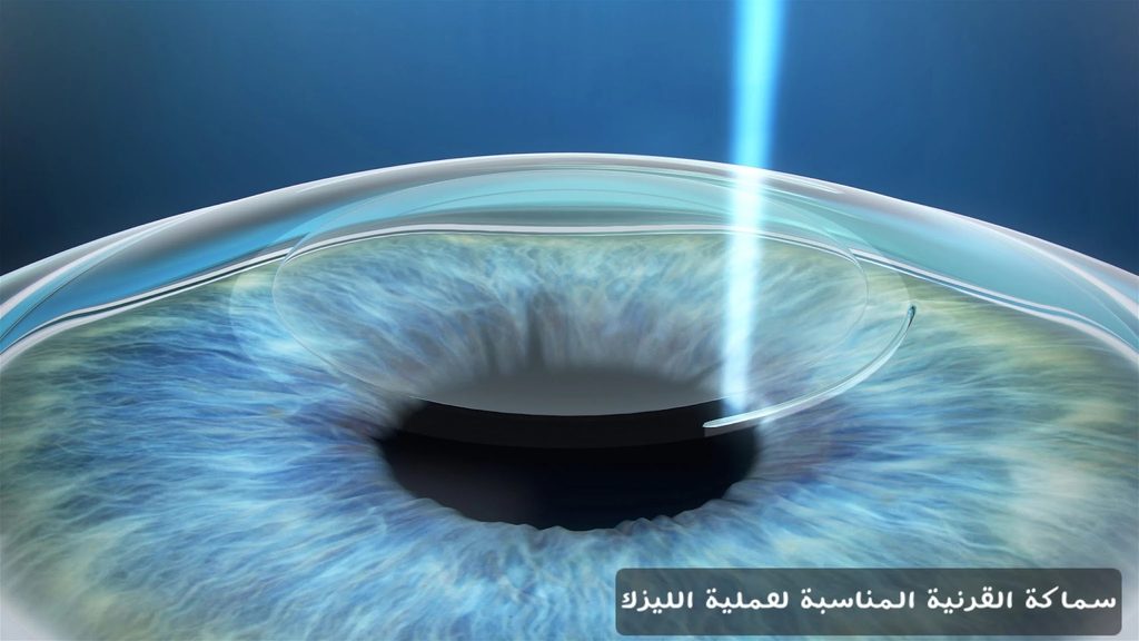 سماكة القرنية المناسبة لعملية الليزك 3 image 13 سماكة القرنية المناسبة لعملية الليزك
