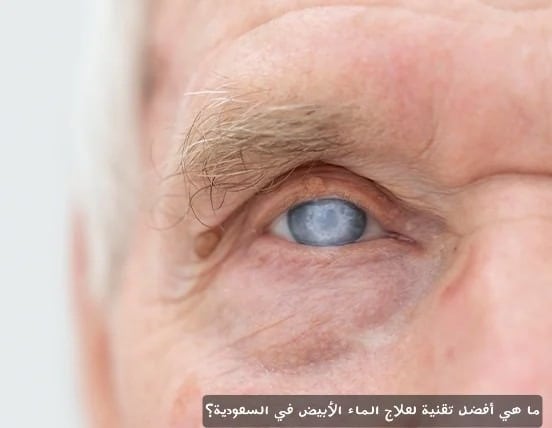 ما هي أفضل تقنية لعلاج الماء الأبيض في السعودية؟ 2 image 2 ما هي أفضل تقنية لعلاج الماء الأبيض في السعودية؟