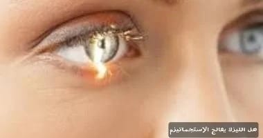 هل الليزك يعالج الاستجماتيزم 1 image 20 هل الليزك يعالج الاستجماتيزم