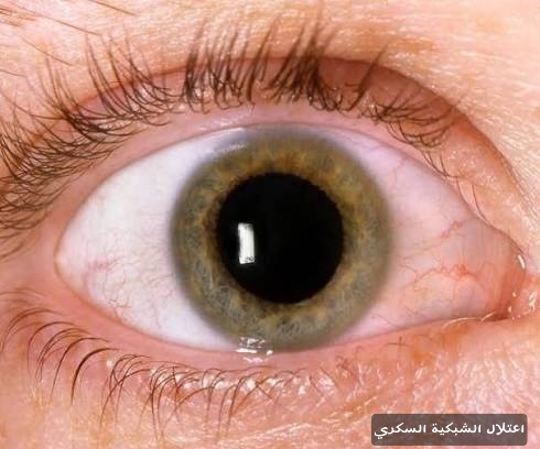 اعتلال الشبكية السكري 1 اعتلال الشبكية السكري