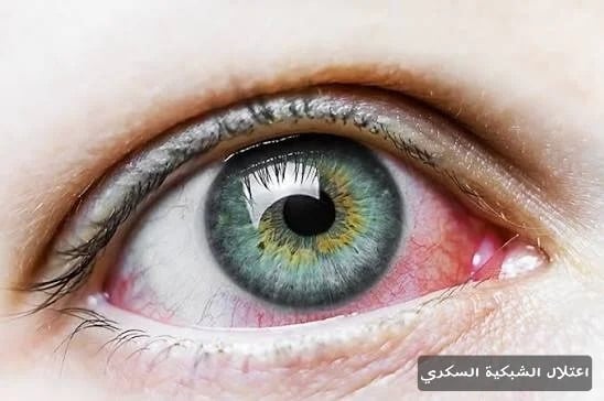 اعتلال الشبكية السكري 3 image 25 اعتلال الشبكية السكري