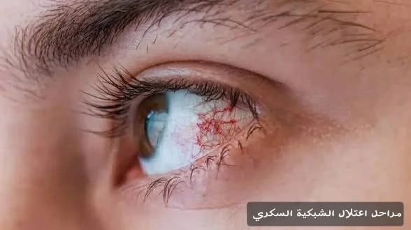 مراحل اعتلال الشبكية السكري 1 image 28 مراحل اعتلال الشبكية السكري